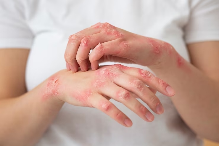 Ожог кожи: регенерация и восстановление | АМО — Академии медицинского образования